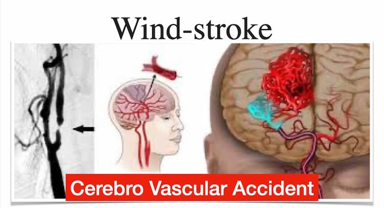 course |  TCM for Wind Stroke , Paralysis , Hemiplegia